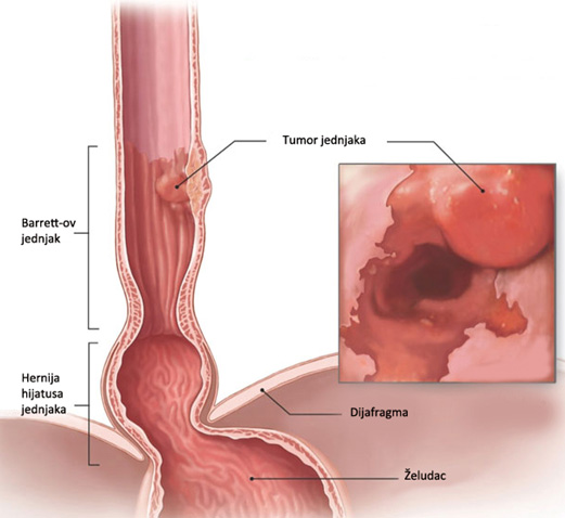 Metaplasia and dysplasia: Video, Anatomy & Definition