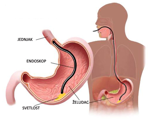 upper-gi-endoscopy