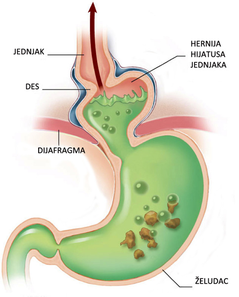 What Causes Regurgitation After Eating