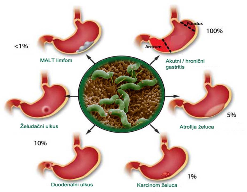 gyomorrák h pylori-ból papillomatosis és hyperkeratosis