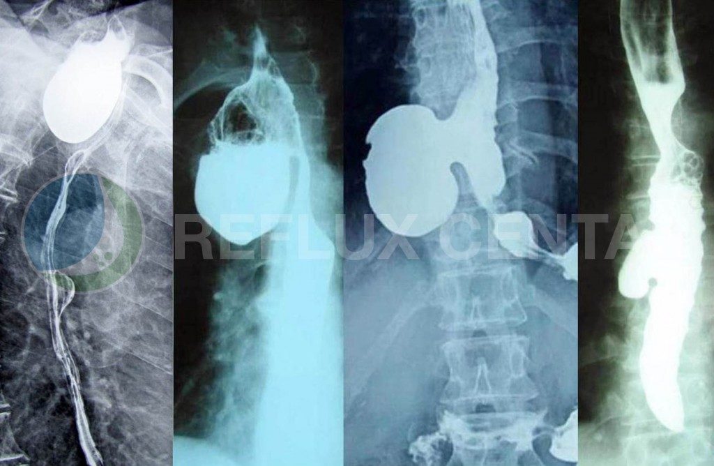 Radiografija Zenker-ovog, epifreničnog i mediotorakalnog divertikuluma