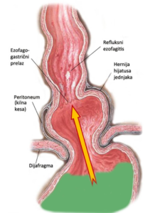 Hernija hijatusa jednjaka, refluks i erozivni ezofagitis