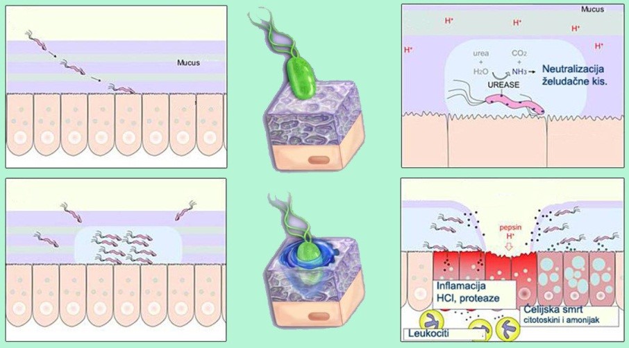 Helicobacter pylori gastritis